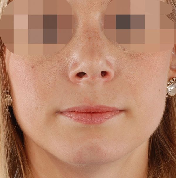 Tip Case 2606 After Photo Tip