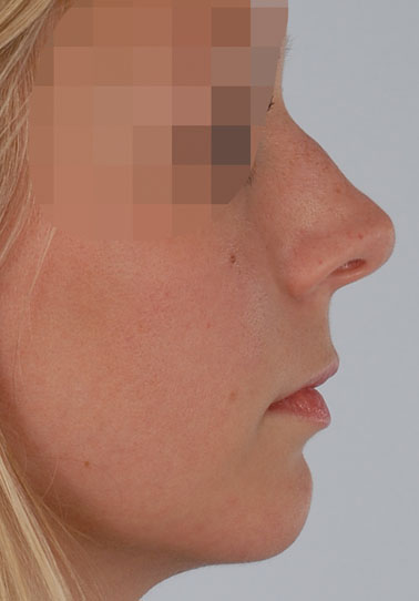 Tip Case 2606 Before Photo Tip