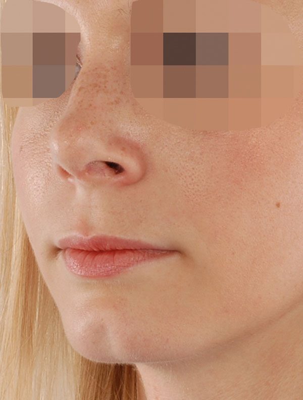 Tip Case 2606 After Photo Tip