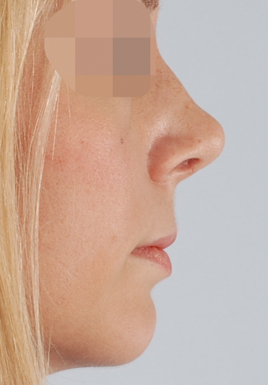 Tip Case 2606 After Photo Tip