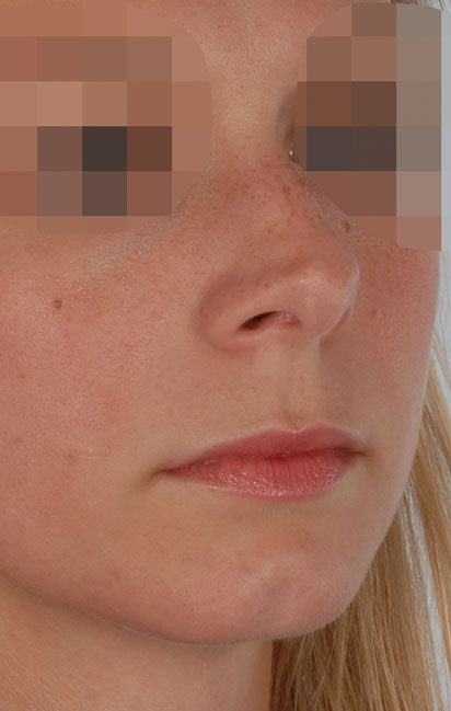 Tip Case 2606 Before Photo Tip