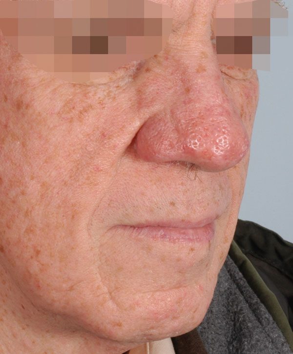 Tip Case 2618 After Photo Tip