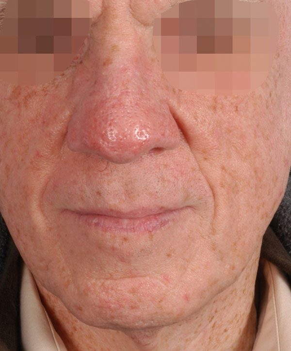 Tip Case 2618 After Photo Tip