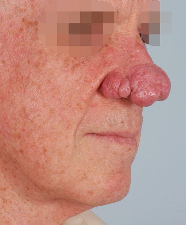 Tip Case 2618 Before Photo Tip