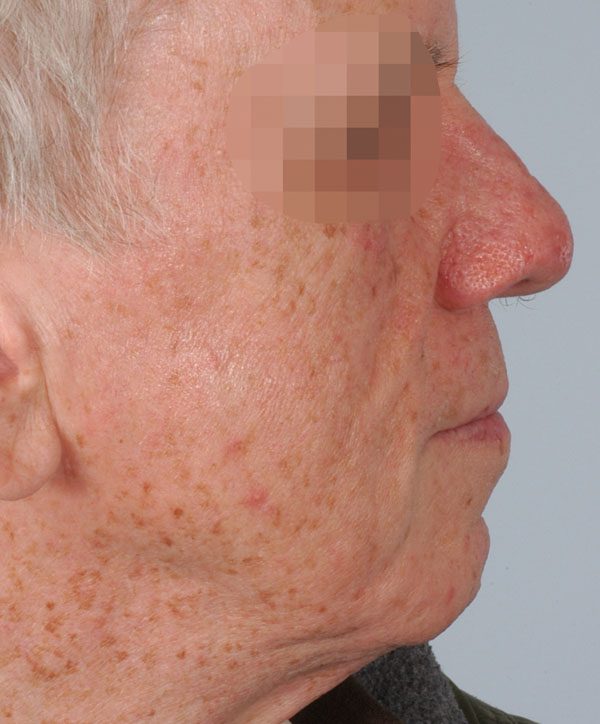 Tip Case 2618 After Photo Tip