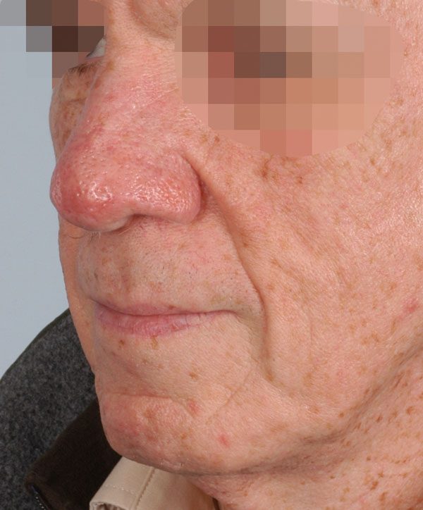 Tip Case 2618 After Photo Tip