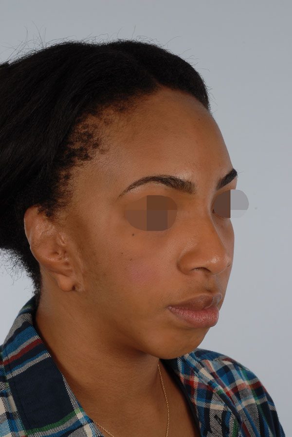Facial Reconstruction Case 2693 Before Photo Facial Reconstruction