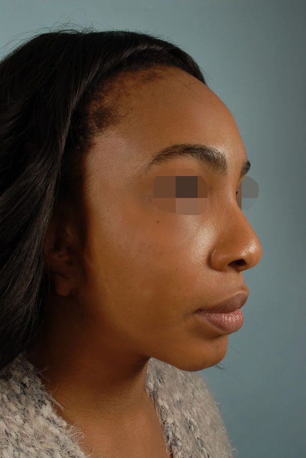 Facial Reconstruction Case 2693 After Photo Facial Reconstruction