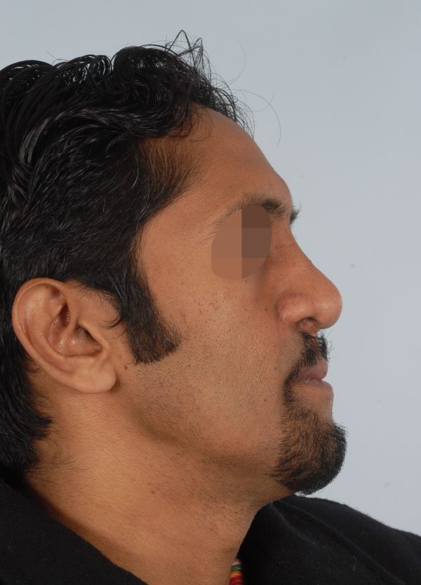 Facial Reconstruction Case 2705 After Photo Facial Reconstruction