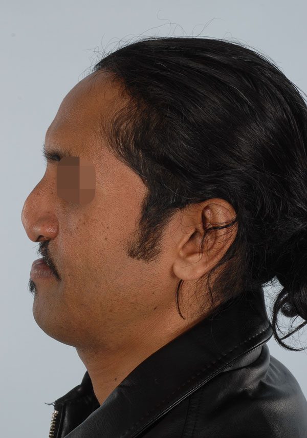Facial Reconstruction Case 2705 Before Photo Facial Reconstruction