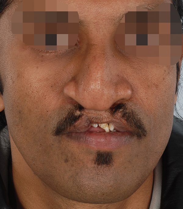 Facial Reconstruction Case 2705 Before Photo Facial Reconstruction