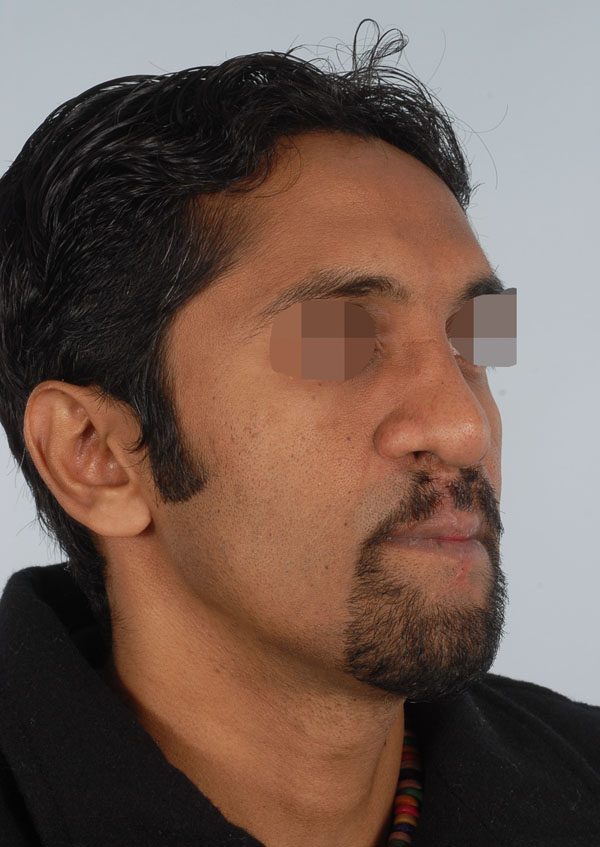 Facial Reconstruction Case 2705 After Photo Facial Reconstruction