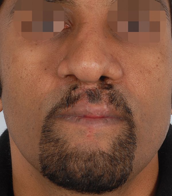 Facial Reconstruction Case 2705 After Photo Facial Reconstruction