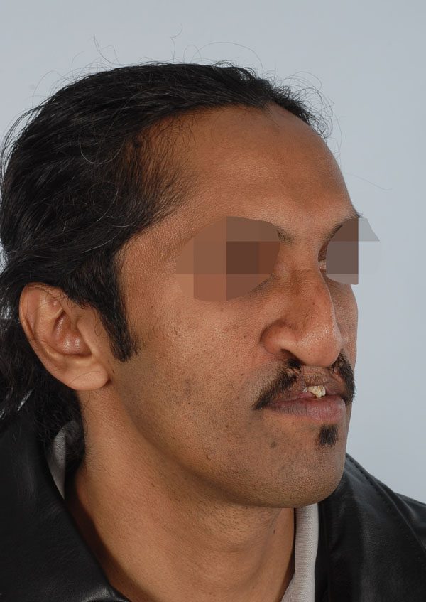 Facial Reconstruction Case 2705 Before Photo Facial Reconstruction