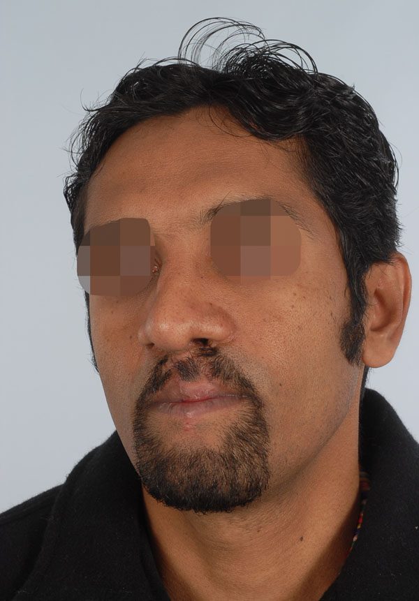 Facial Reconstruction Case 2705 After Photo Facial Reconstruction
