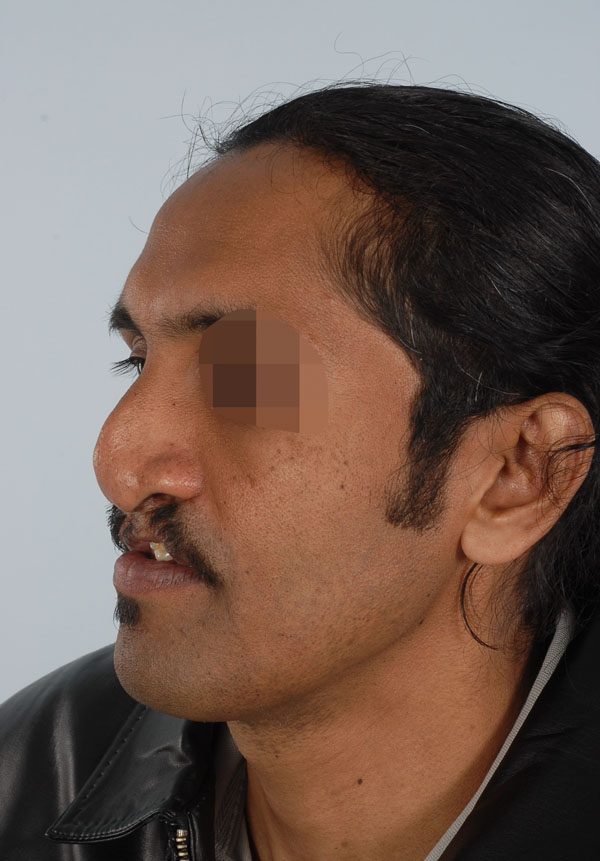 Facial Reconstruction Case 2705 Before Photo Facial Reconstruction