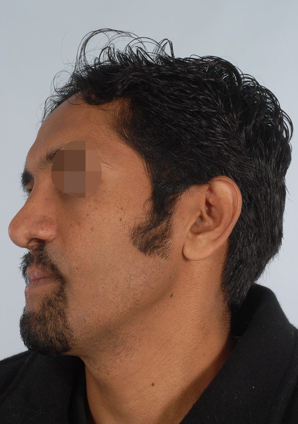 Facial Reconstruction Case 2705 After Photo Facial Reconstruction