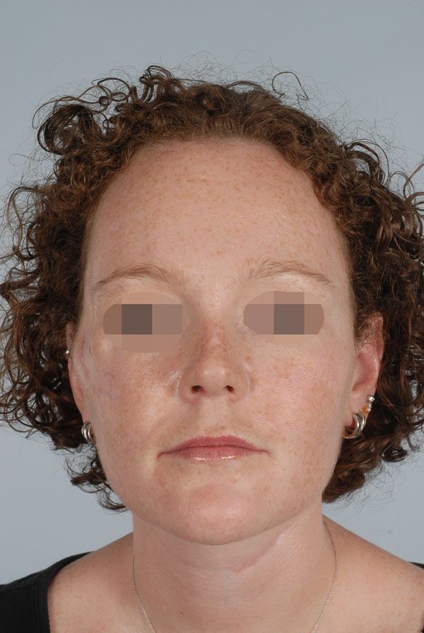 Facial Reconstruction Case 2723 Before Photo Facial Reconstruction
