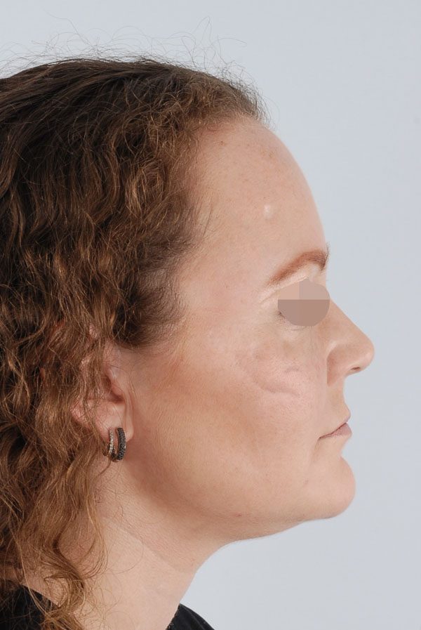 Facial Reconstruction Case 2723 After Photo Facial Reconstruction