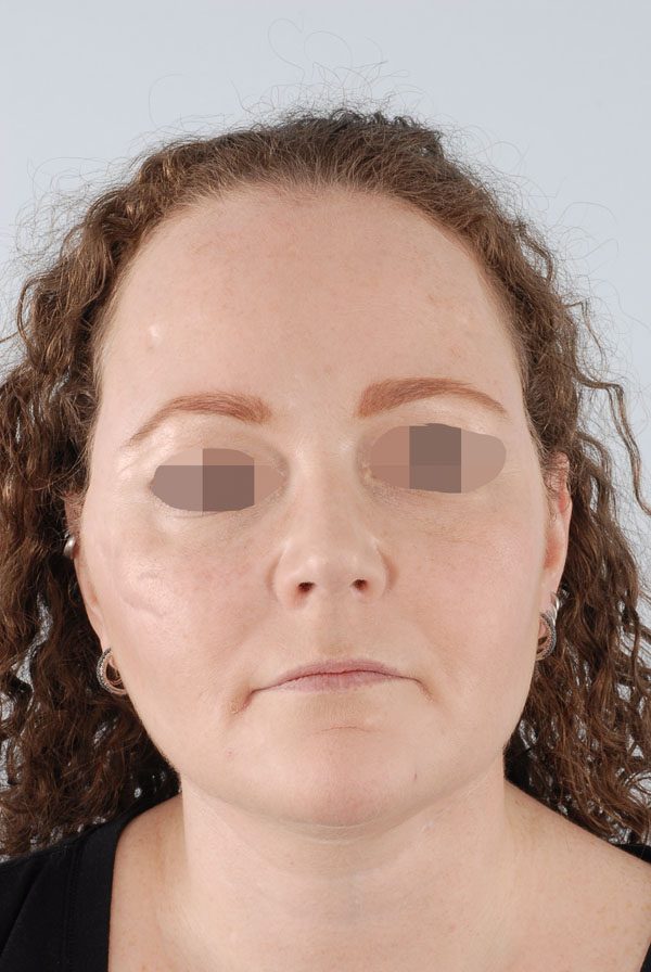 Facial Reconstruction Case 2723 After Photo Facial Reconstruction