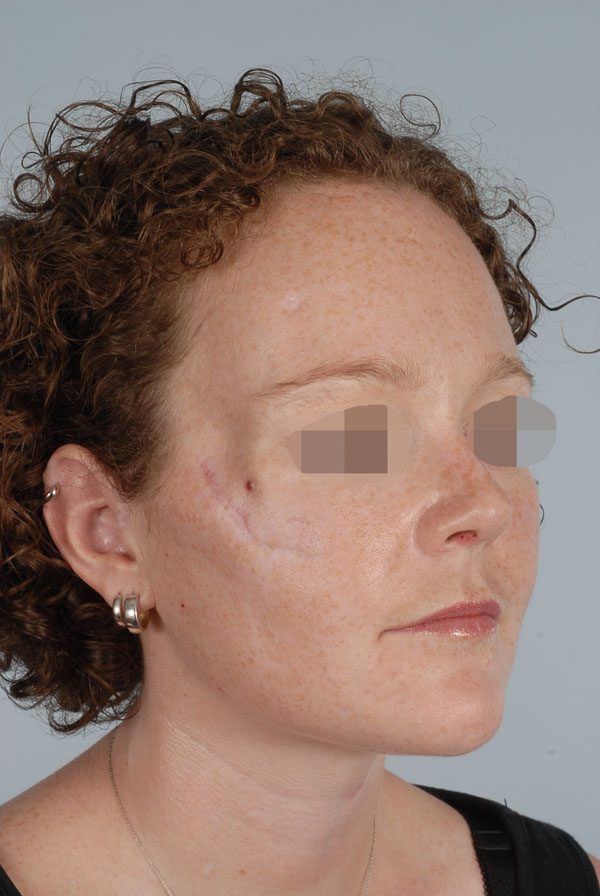 Facial Reconstruction Case 2723 Before Photo Facial Reconstruction