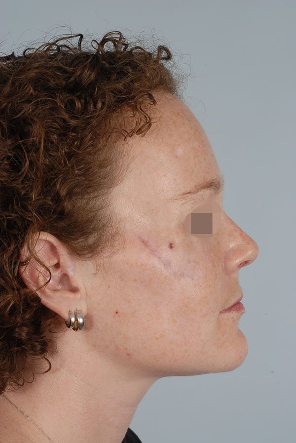 Facial Reconstruction Case 2723 Before Photo Facial Reconstruction