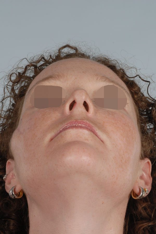 Facial Reconstruction Case 2723 Before Photo Facial Reconstruction