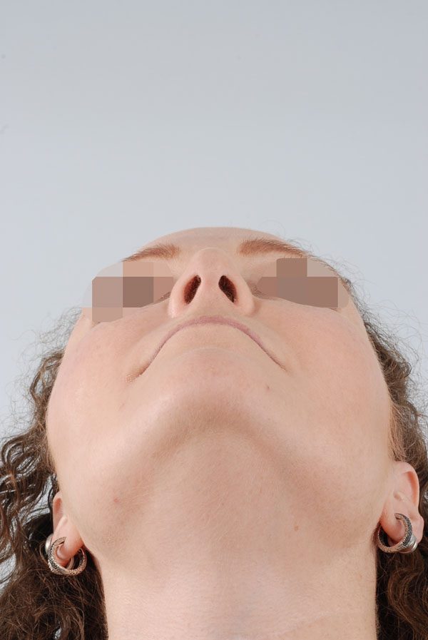 Facial Reconstruction Case 2723 After Photo Facial Reconstruction
