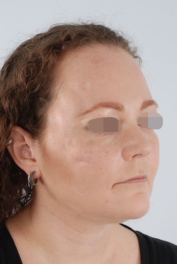 Facial Reconstruction Case 2723 After Photo Facial Reconstruction
