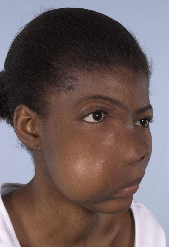 Facial Reconstruction Case 2733 Before Photo Facial Reconstruction