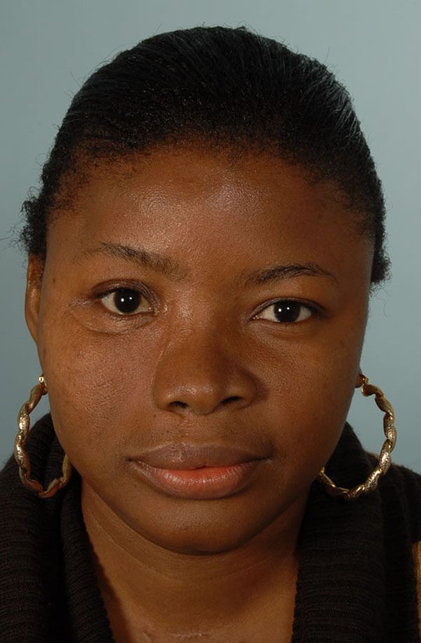 Facial Reconstruction Case 2733 After Photo Facial Reconstruction