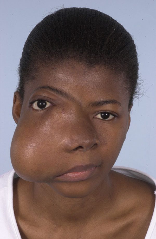 Facial Reconstruction Case 2733 Before Photo Facial Reconstruction