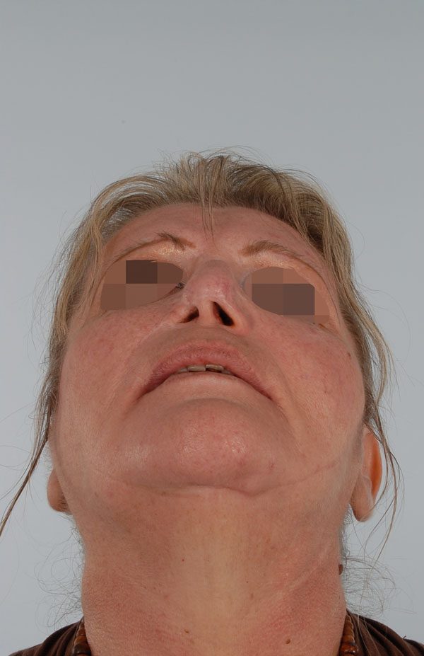 Facial Reconstruction Case 2759 After Photo Facial Reconstruction
