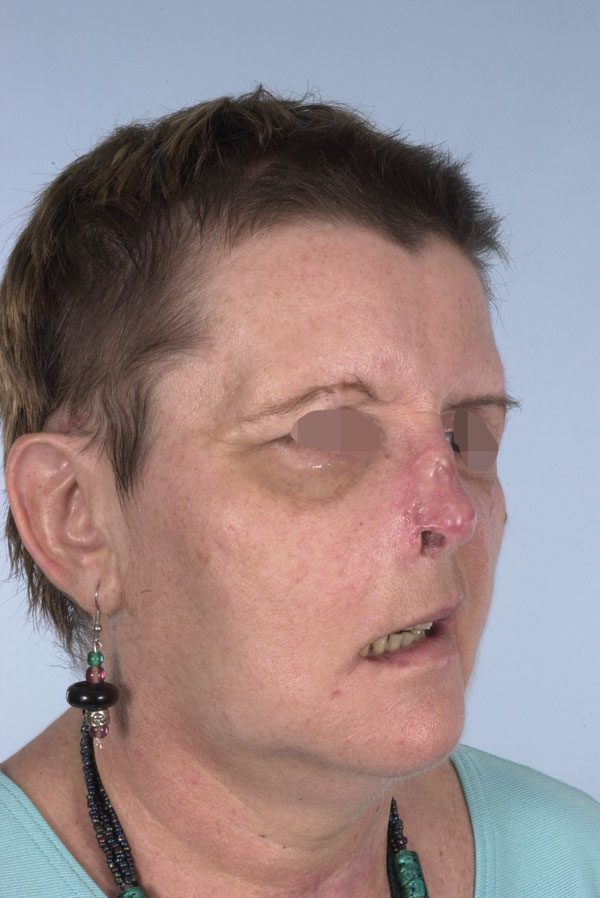 Facial Reconstruction Case 2759 Before Photo Facial Reconstruction