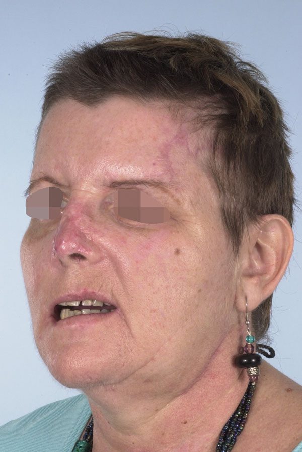 Facial Reconstruction Case 2759 Before Photo Facial Reconstruction
