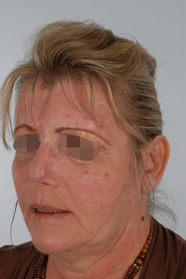 Facial Reconstruction Case 2759 After Photo Facial Reconstruction