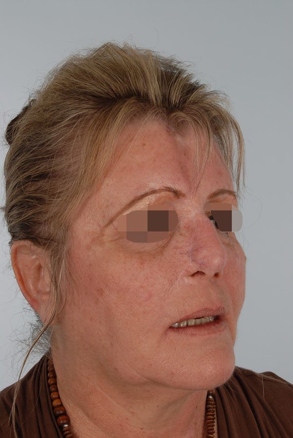 Facial Reconstruction Case 2759 After Photo Facial Reconstruction