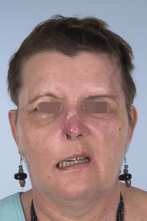 Facial Reconstruction Case 2759 Before Photo Facial Reconstruction