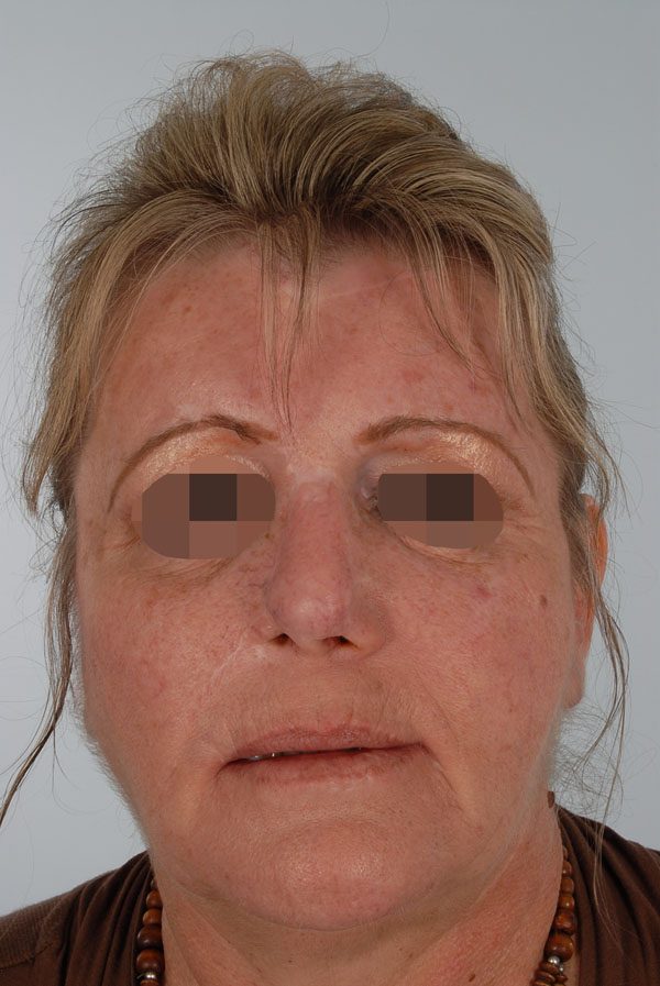 Facial Reconstruction Case 2759 After Photo Facial Reconstruction