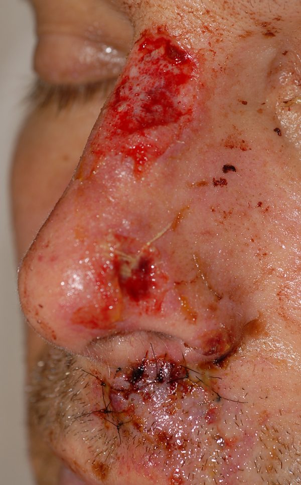 Facial Reconstruction Case 2769 Before Photo Facial Reconstruction