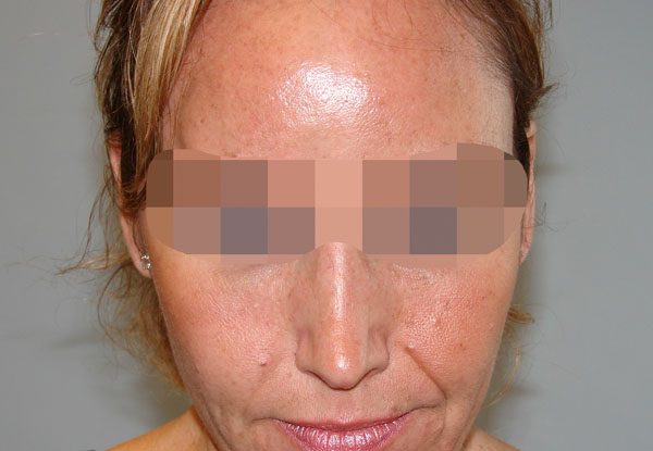 Facial Reconstruction Case 2771 After Photo Facial Reconstruction