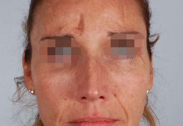 Facial Reconstruction Case 2771 Before Photo Facial Reconstruction