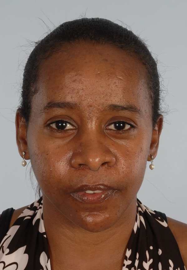 Facial Reconstruction Case 2781 After Photo Facial Reconstruction