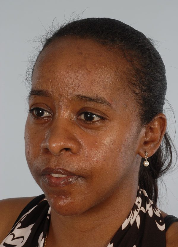 Facial Reconstruction Case 2781 After Photo Facial Reconstruction