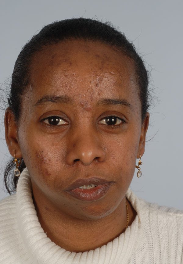 Facial Reconstruction Case 2781 Before Photo Facial Reconstruction