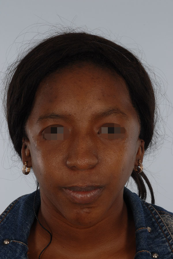 Facial Reconstruction Case 2791 After Photo Facial Reconstruction