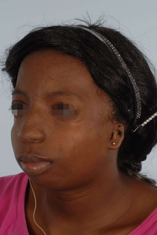 Facial Reconstruction Case 2791 Before Photo Facial Reconstruction