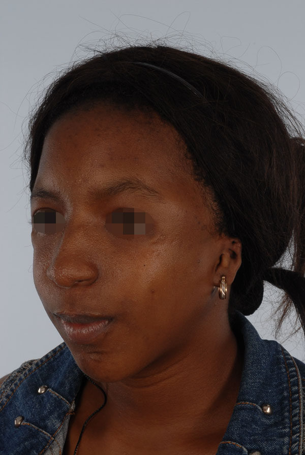 Facial Reconstruction Case 2791 After Photo Facial Reconstruction