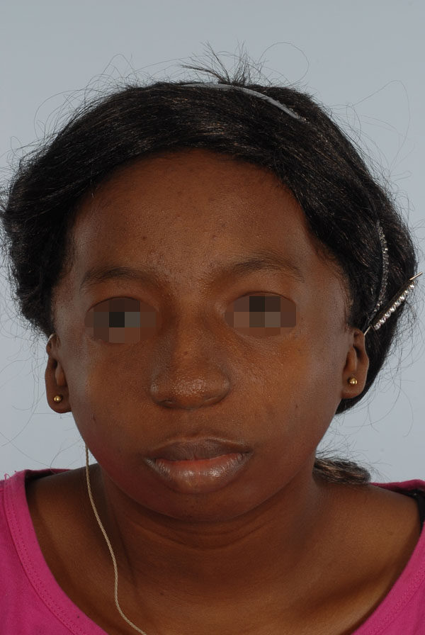 Facial Reconstruction Case 2791 Before Photo Facial Reconstruction