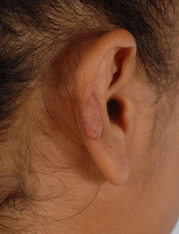 Keloid Case 2831 After Photo Keloid